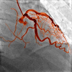 Normal blood vessels, X-ray