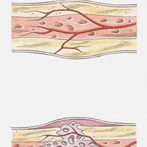 Sequence of illustrations showing complete bone fracture and healing process
