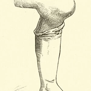 Housemaids Knee (engraving)