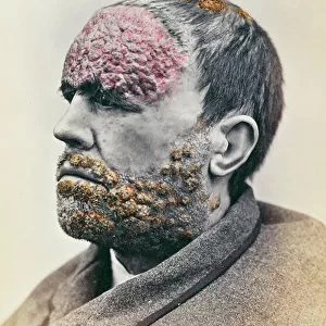 Man suffering from syphilis, from a photograph taken for the Clinique Photographique de