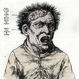 Representation of a mental insane (mad) suffering from general paralysis in a fit of rage Engraving from " La nature et l'homme" by Rengade 1881 Private collection