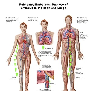 Pulmonary embolism, pathway of embolus to the heart and lungs